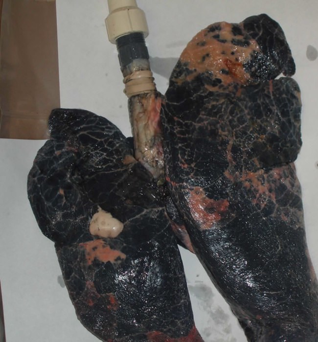 Легкие курильщика