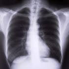 Рак легких Рак легких