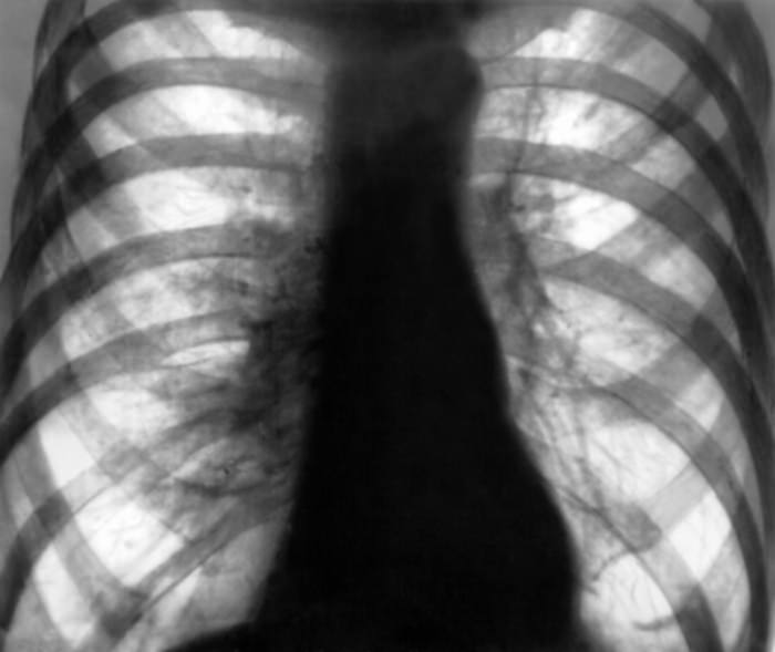 Рентген эмфиземы легких Рентген эмфиземы легких