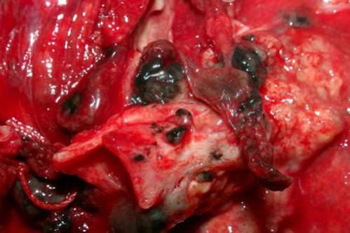 Удаленная раковая опухоль