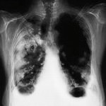 Рак легких - самый безжалостный убийца