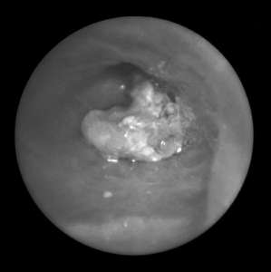 Рак легких - масштабы катастрофы